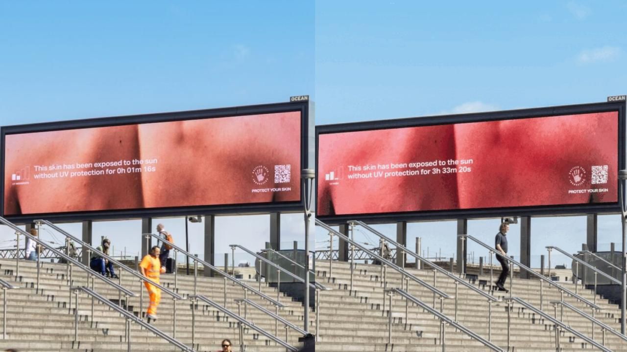 Outdoor “sofre queimaduras” para exibir perigos da exposição solar