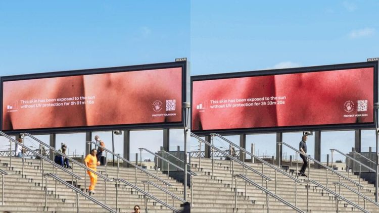 Outdoor “sofre queimaduras” para exibir perigos da exposição solar